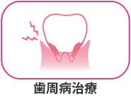 歯周病治療